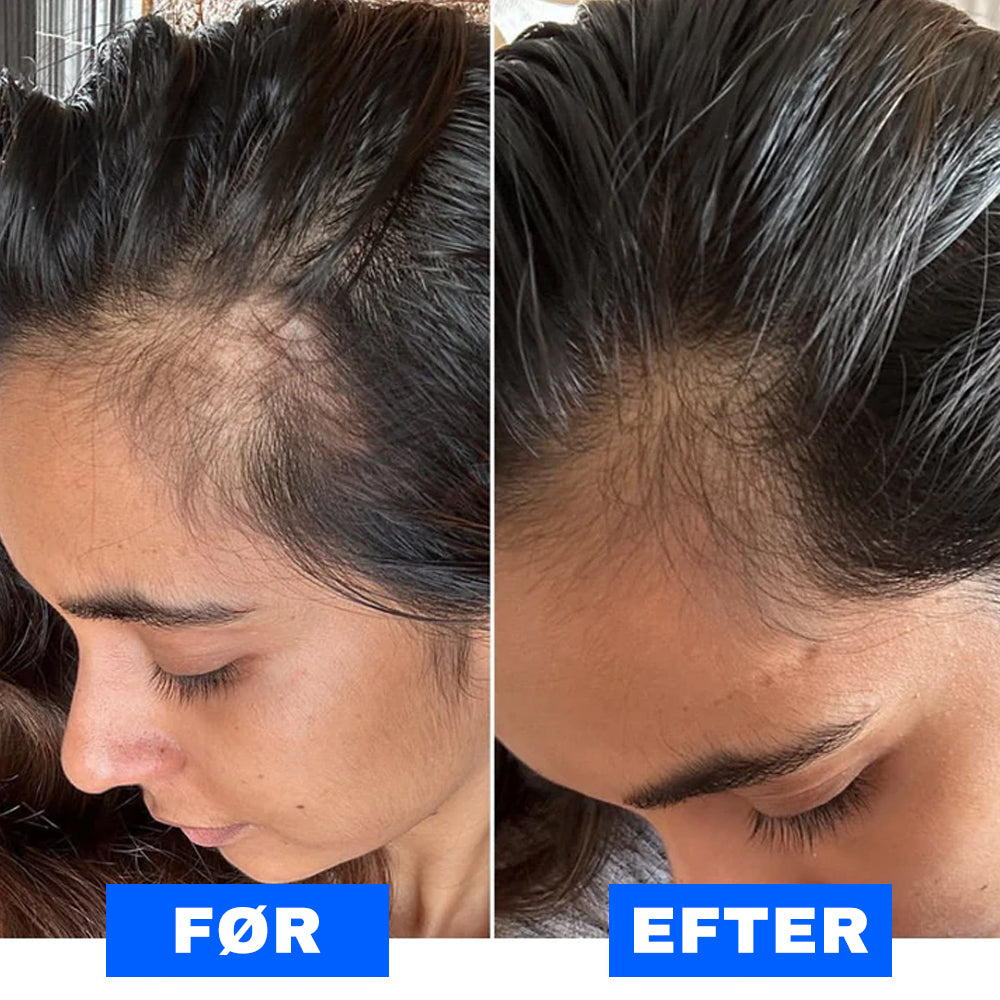 ZenEase™ - Premium-Kopfhautmassagegerät